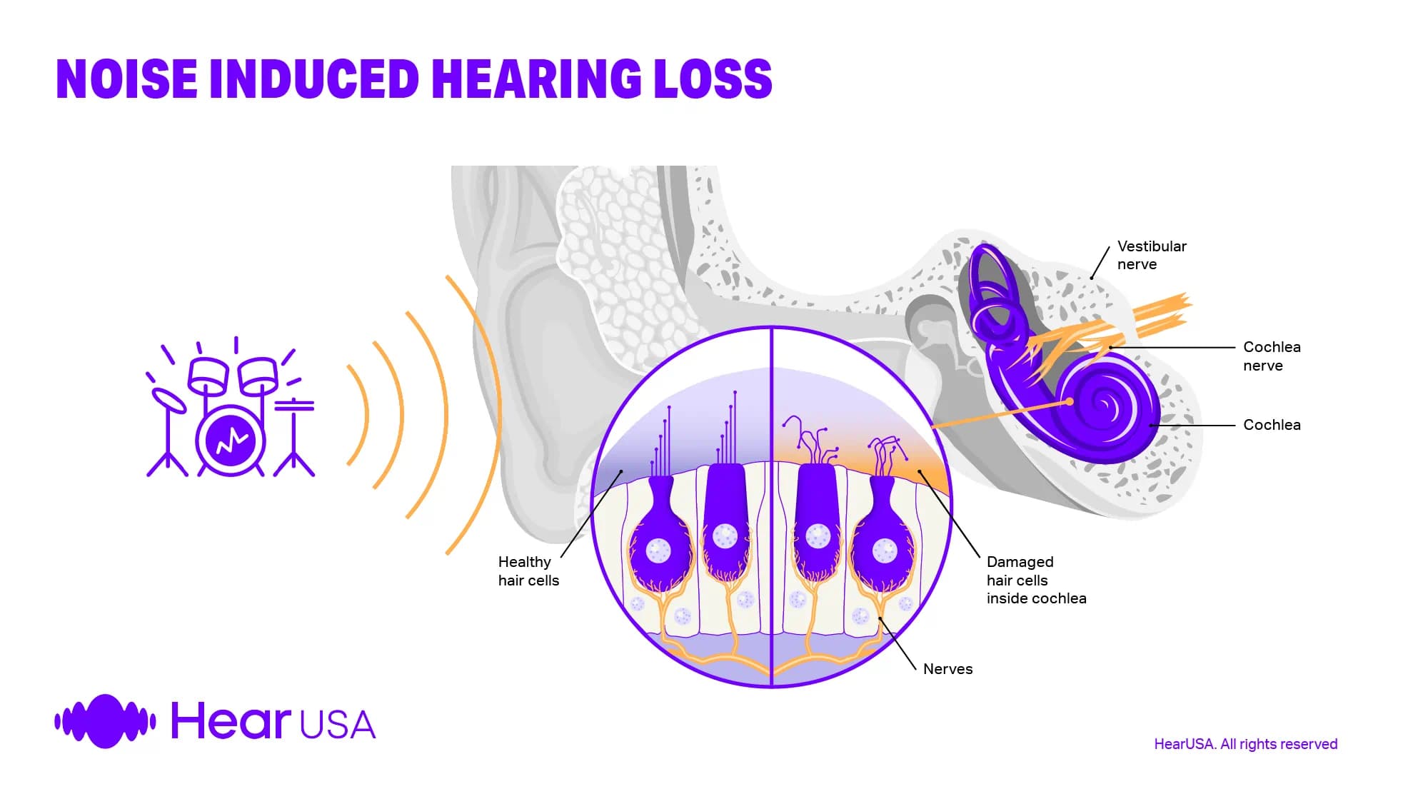 Hearing loss caused by being exposed to noise can be helped by wearing hearing aids