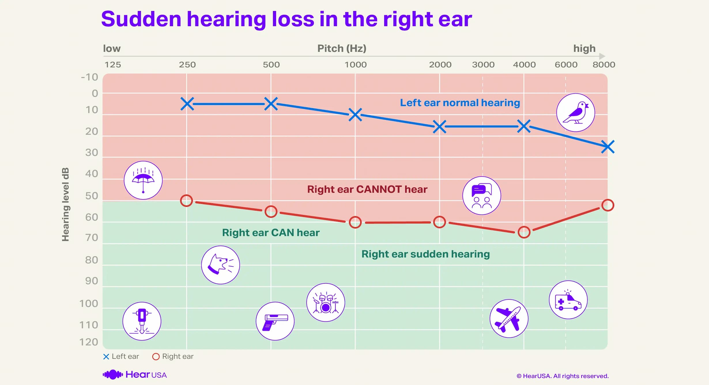 Sudden hearing loss right ear audiogram