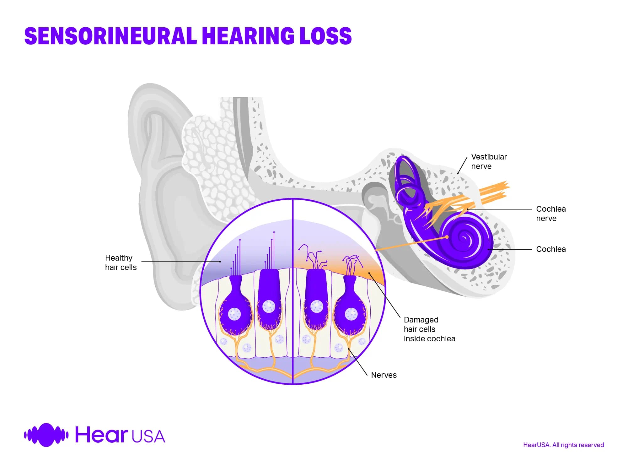 Sensorineural hearing loss is caused by inner ear problems but can be helped by wearing hearing aids